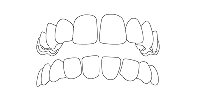 Bei Lücken zwischen den Zähnen