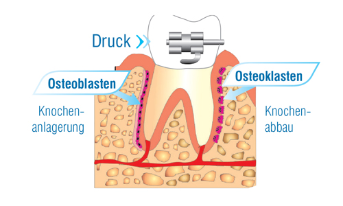 AcceleDent Wie sich Zähne durch Knochen bewegen