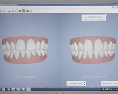 Invisalign Ergebnissimulator auf dem iTero Scanner Kieferorthopädie Dricke & Ritschel Dortmund